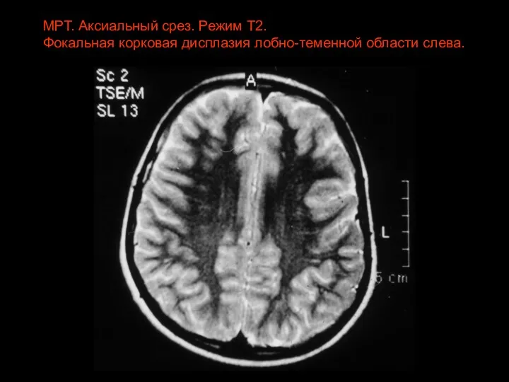 МРТ. Аксиальный срез. Режим Т2. Фокальная корковая дисплазия лобно-теменной области слева.