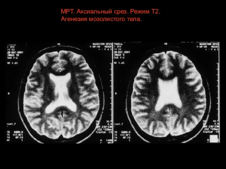 МРТ. Аксиальный срез. Режим Т2. Агенезия мозолистого тела.