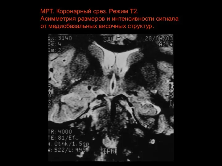 МРТ. Коронарный срез. Режим Т2. Асимметрия размеров и интенсивности сигнала от медиобазальных височных структур.