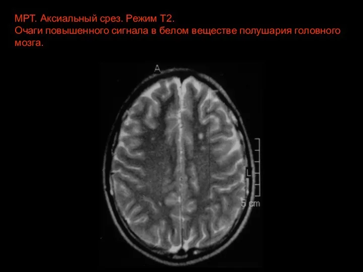 МРТ. Аксиальный срез. Режим Т2. Очаги повышенного сигнала в белом веществе полушария головного мозга.