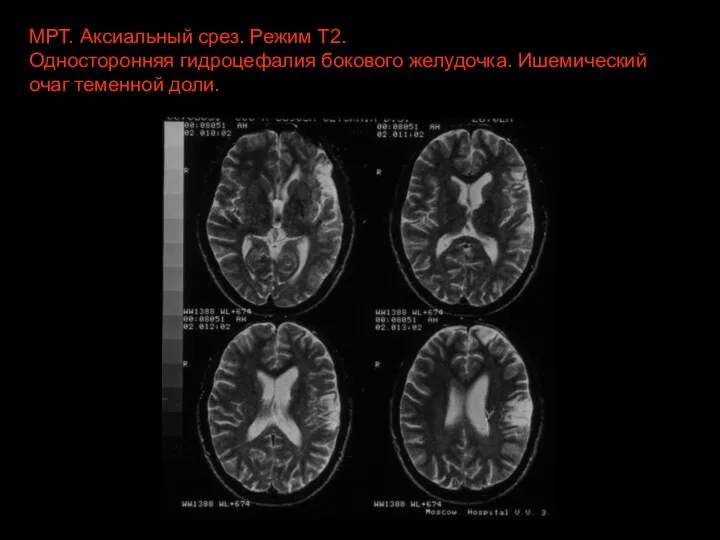 МРТ. Аксиальный срез. Режим Т2. Односторонняя гидроцефалия бокового желудочка. Ишемический очаг теменной доли.