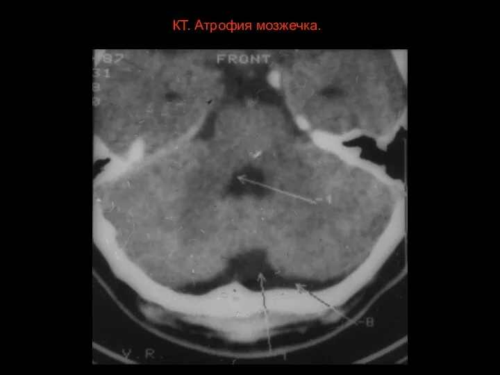 КТ. Атрофия мозжечка.