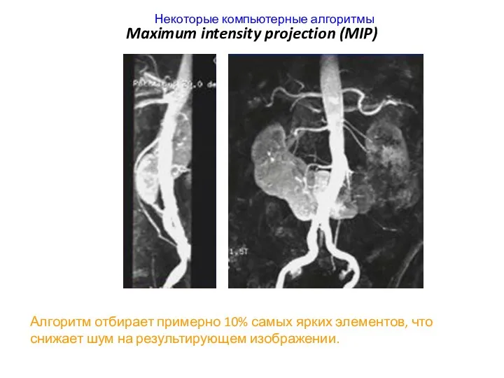 Maximum intensity projection (MIP) Алгоритм отбирает примерно 10% самых ярких