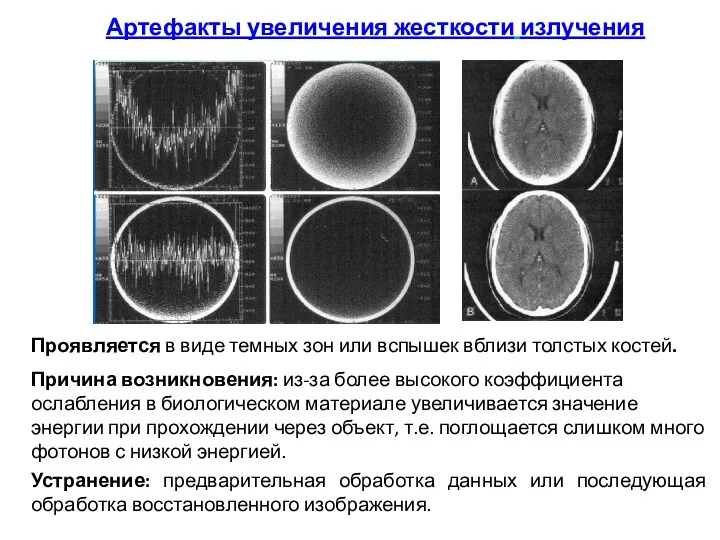 Артефакты увеличения жесткости излучения Проявляется в виде темных зон или