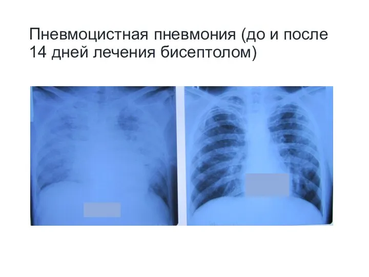 Пневмоцистная пневмония (до и после 14 дней лечения бисептолом)