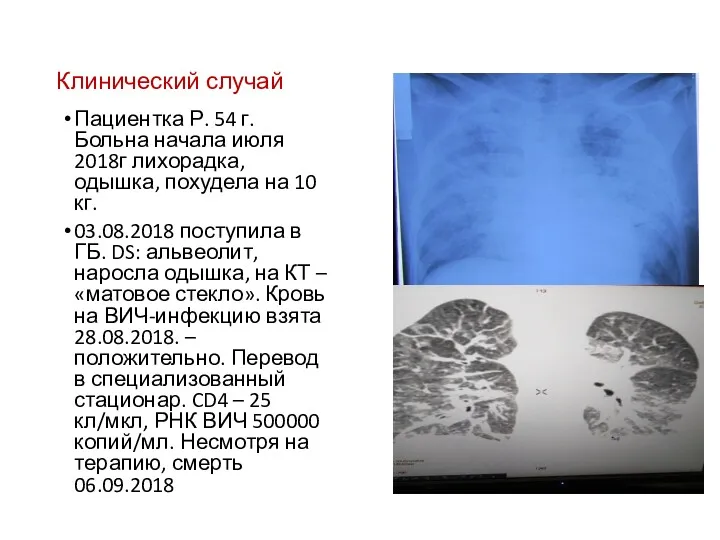 Клинический случай Пациентка Р. 54 г. Больна начала июля 2018г