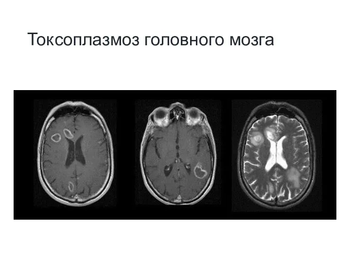 Токсоплазмоз головного мозга