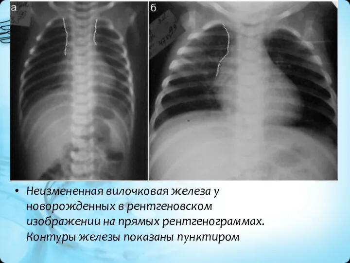 Неизмененная вилочковая железа у новорожденных в рентгеновском изображении на прямых рентгенограммах. Контуры железы показаны пунктиром