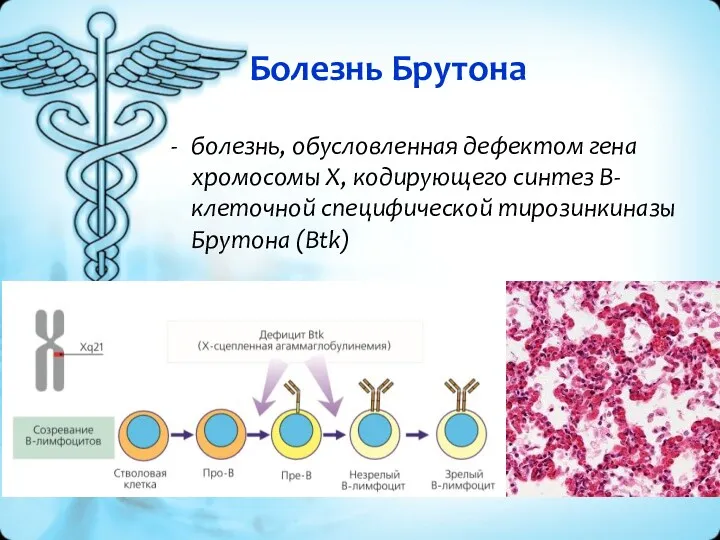 Болезнь Брутона болезнь, обусловленная дефектом гена хромосомы X, кодирующего синтез B-клеточной специфической тирозинкиназы Брутона (Btk)