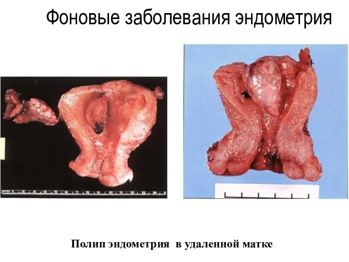 Полип эндометрия в удаленной матке Фоновые заболевания эндометрия