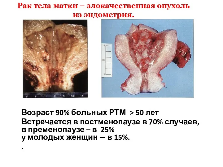 Возраст 90% больных РТМ > 50 лет Встречается в постменопаузе