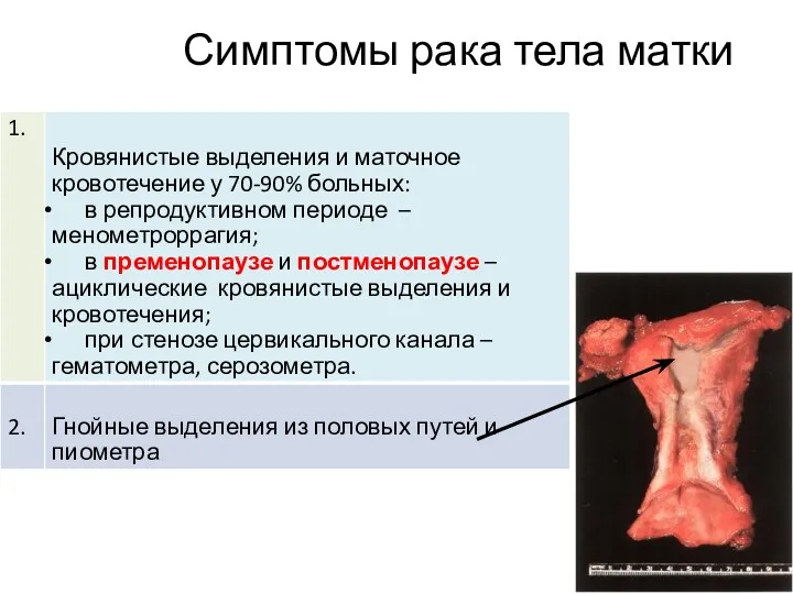 Симптомы рака тела матки