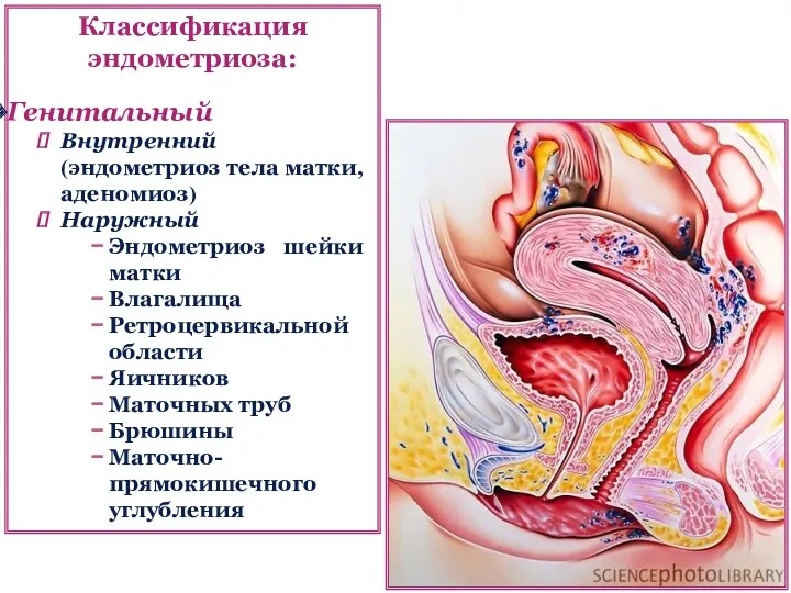 Классификация эндометриоза: Генитальный Внутренний (эндометриоз тела матки, аденомиоз) Наружный Эндометриоз