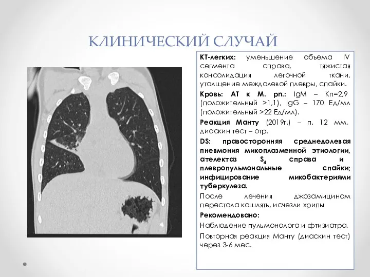 КЛИНИЧЕСКИЙ СЛУЧАЙ КТ-легких: уменьшение объема IV сегмента справа, тяжистая консолидация