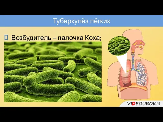 Туберкулёз лёгких Возбудитель – палочка Коха; микроорганизмы долгое время могут находиться внутри тела,