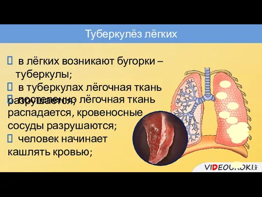 Туберкулёз лёгких в лёгких возникают бугорки – туберкулы; в туберкулах лёгочная ткань разрушается;