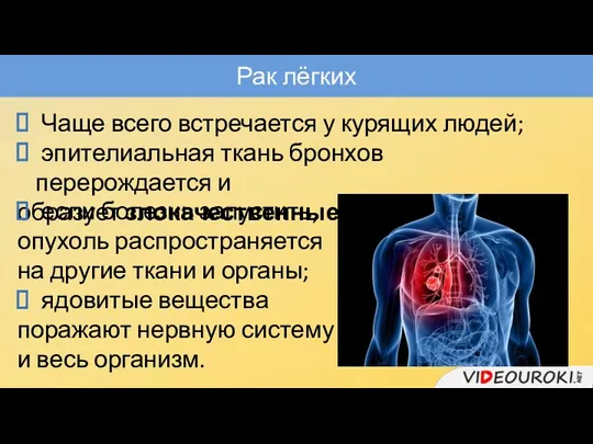 Рак лёгких Чаще всего встречается у курящих людей; эпителиальная ткань бронхов перерождается и
