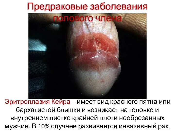 Предраковые заболевания полового члена Эритроплазия Кейра – имеет вид красного пятна или бархатистой