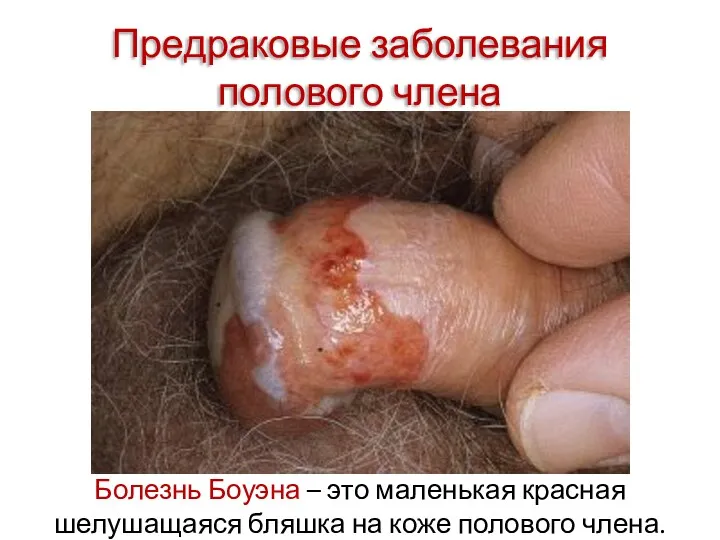 Предраковые заболевания полового члена Болезнь Боуэна – это маленькая красная шелушащаяся бляшка на коже полового члена.