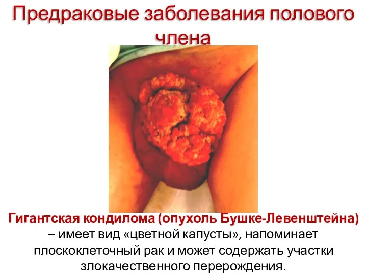 Предраковые заболевания полового члена Гигантская кондилома (опухоль Бушке-Левенштейна) – имеет вид «цветной капусты»,