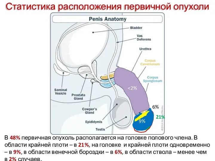 Статистика расположения первичной опухоли В 48% первичная опухоль располагается на головке полового члена.