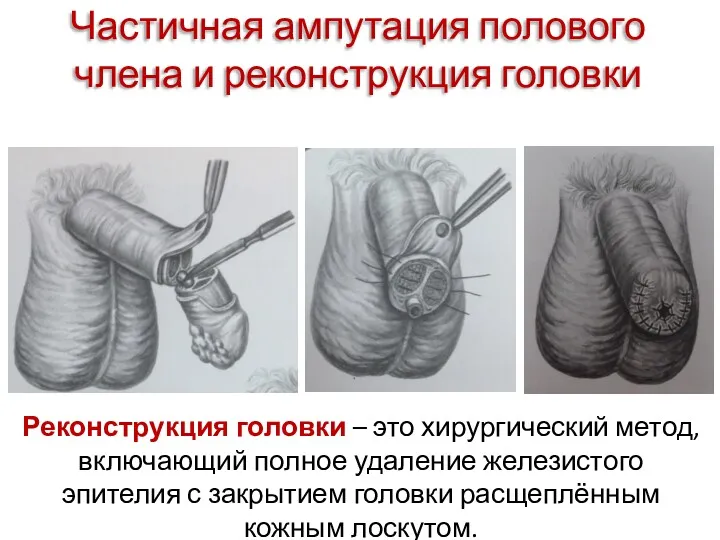 Частичная ампутация полового члена и реконструкция головки Реконструкция головки –