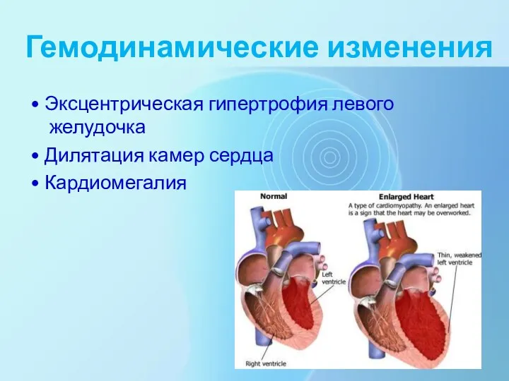 Гемодинамические изменения • Эксцентрическая гипертрофия левого желудочка • Дилятация камер сердца • Кардиомегалия