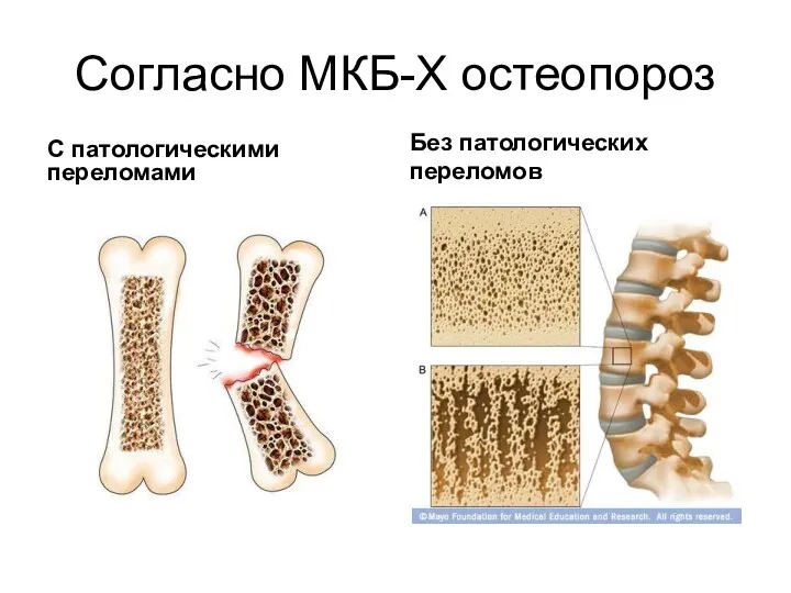 Согласно МКБ-X остеопороз С патологическими переломами Без патологических переломов