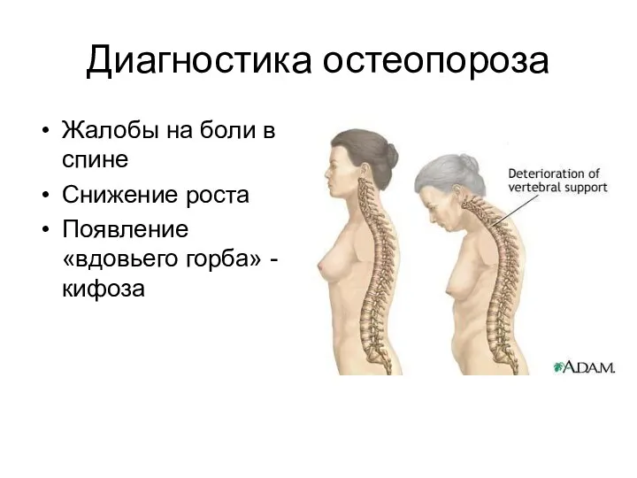 Диагностика остеопороза Жалобы на боли в спине Снижение роста Появление «вдовьего горба» - кифоза