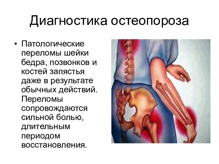 Диагностика остеопороза Патологические переломы шейки бедра, позвонков и костей запястья