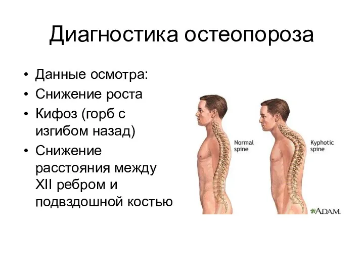 Диагностика остеопороза Данные осмотра: Снижение роста Кифоз (горб с изгибом