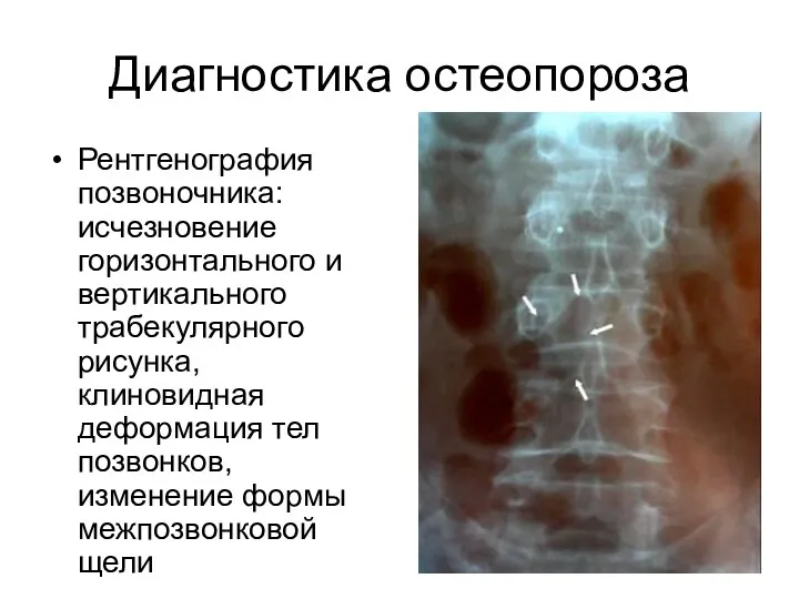 Диагностика остеопороза Рентгенография позвоночника: исчезновение горизонтального и вертикального трабекулярного рисунка,