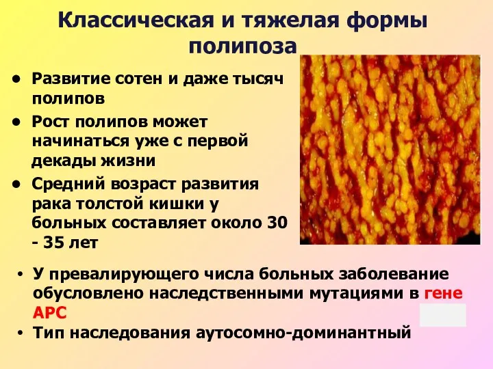 Классическая и тяжелая формы полипоза Развитие сотен и даже тысяч