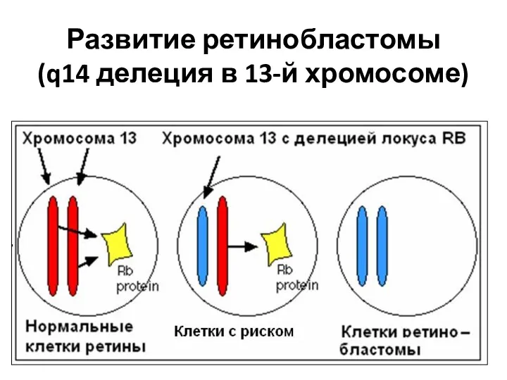 Развитие ретинобластомы (q14 делеция в 13-й хромосоме)