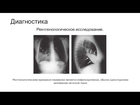 Диагностика Рентгенологическое исследование. Рентгенологическим признаком пневмонии является инфильтративное, обычно одностороннее затемнение легочной ткани.