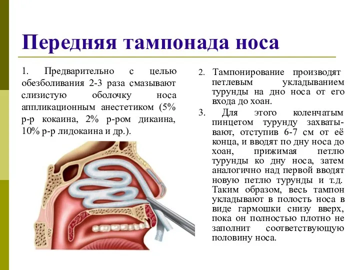 Передняя тампонада носа 2. Тампонирование производят петлевым укладыванием турунды на