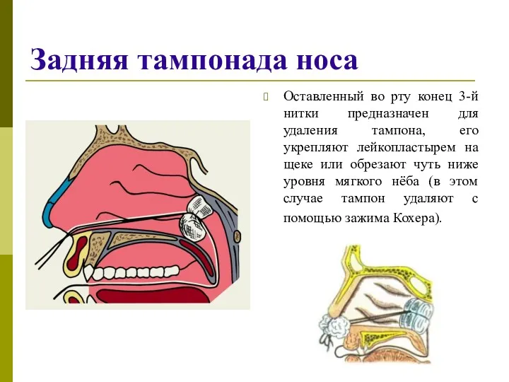 Задняя тампонада носа Оставленный во рту конец 3-й нитки предназначен