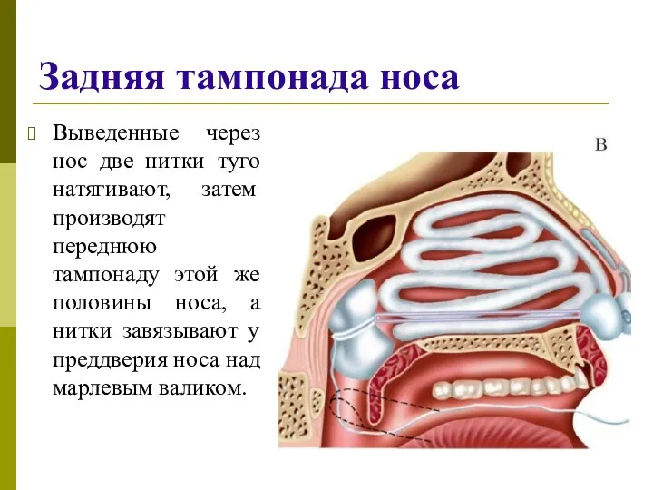 Задняя тампонада носа Выведенные через нос две нитки туго натягивают,