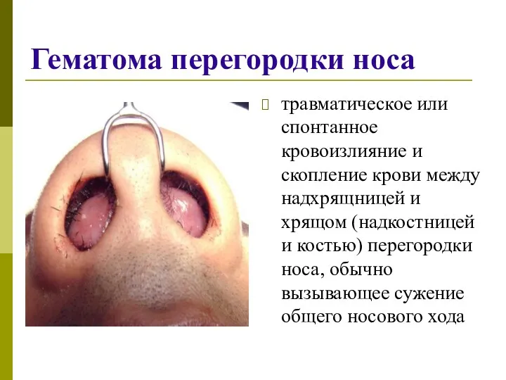 Гематома перегородки носа травматическое или спонтанное кровоизлияние и скопление крови