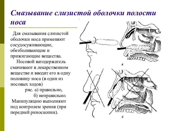 Смазывание слизистой оболочки полости носа Для смазывания слизистой оболочки носа