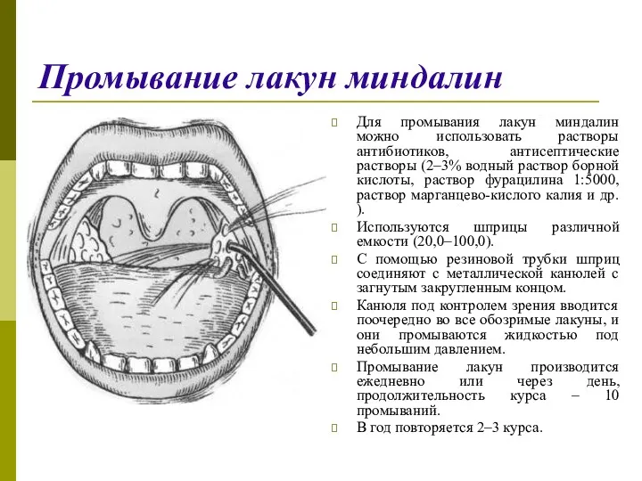 Промывание лакун миндалин Для промывания лакун миндалин можно использовать растворы