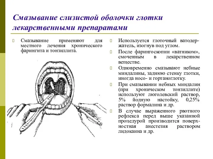 Смазывание слизистой оболочки глотки лекарственными препаратами Смазывание применяют для местного