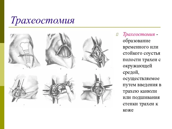 Трахеостомия Трахеостомия - образование временного или стойкого соустья полости трахеи