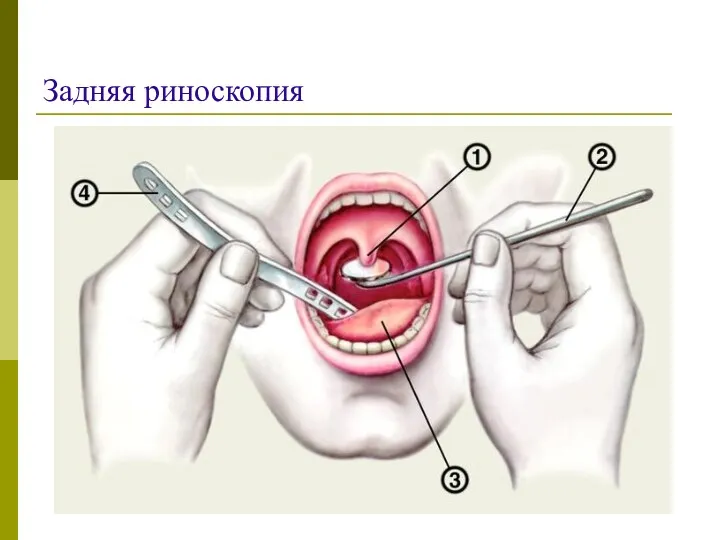 Задняя риноскопия