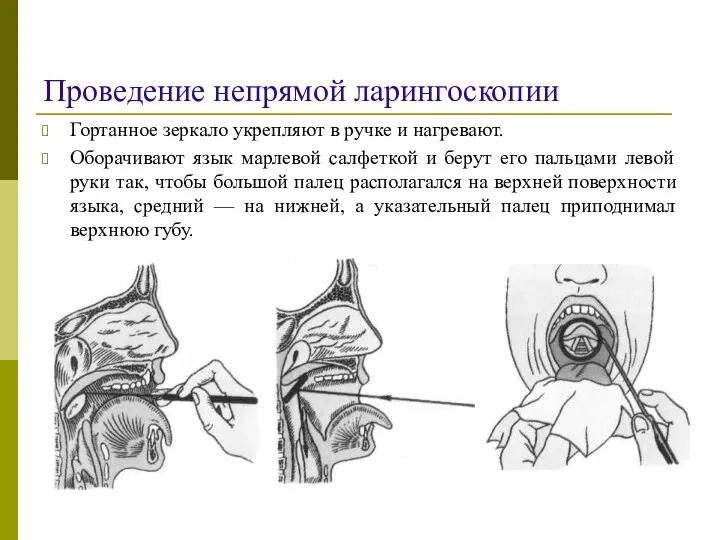 Проведение непрямой ларингоскопии Гортанное зеркало укрепляют в ручке и нагревают.