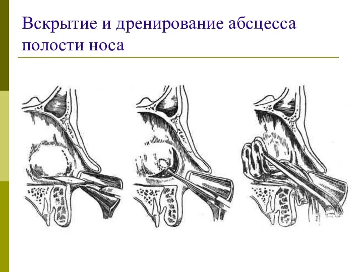 Вскрытие и дренирование абсцесса полости носа