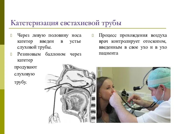 Катетеризация евстахиевой трубы Через левую половину носа катетер введен в