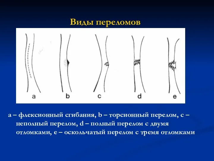 Виды переломов a – флексионный сгибания, b – торсионный перелом,