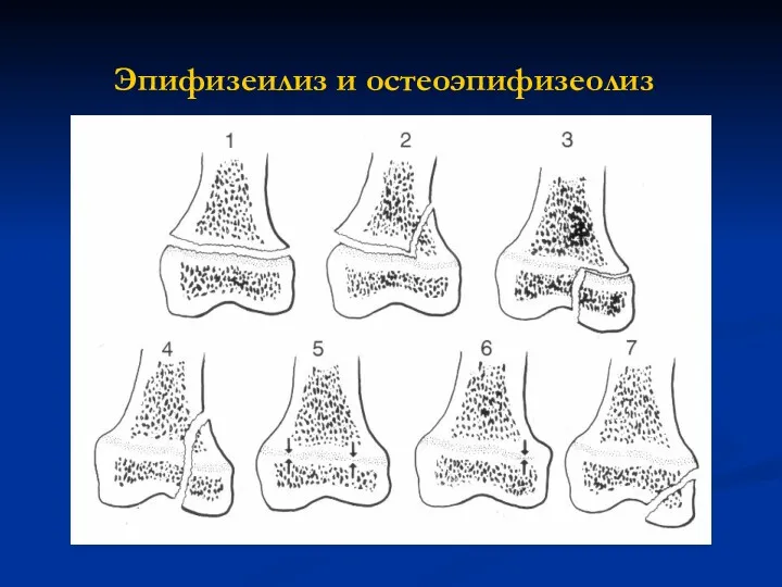 Эпифизеилиз и остеоэпифизеолиз