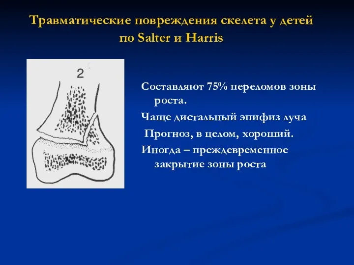 Составляют 75% переломов зоны роста. Чаще дистальный эпифиз луча Прогноз,